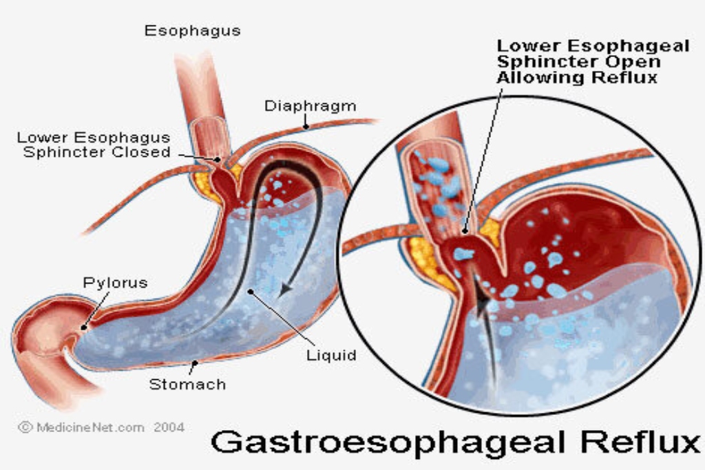 gastroesophageal reflux disease (gerd)